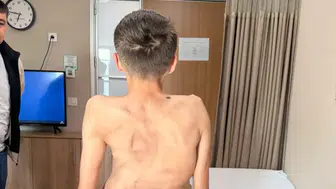 Kırgızistanlı Genç Ankara'da Skolyoz Tedavisiyle Sağlığına Kavuştu